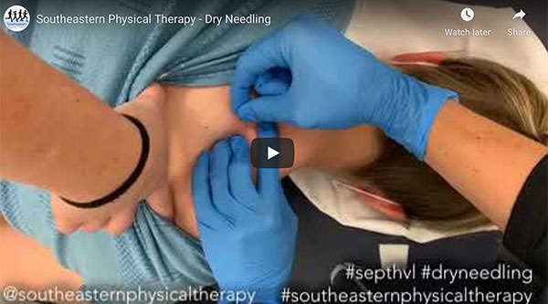 Dry Needling